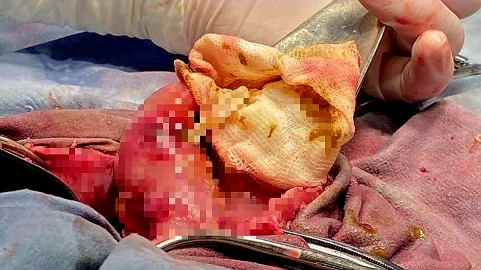 В кишечнике жителя Башкирии врачи обнаружили огромного червя